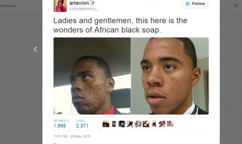 african black soap acne before & after African Soap Before And After, African Black Soap Before And After, African Soap, African Black Soap, Black Soap, Washing Hair, Clear Skin, Soap, Acne