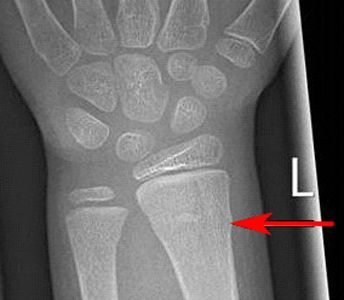 Clinical Practice Guidelines : Distal radius and or ulna metaphyseal fractures - Emergency Department Radius And Ulna, X Rays, Medical Imaging, Emergency Department, Radiology, X Ray, Medical, Buckle, Tattoos