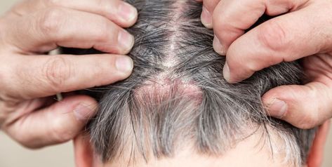 Scalp Psoriasis vs. Dandruff: How to Know What’s Causing Those White Flakes Scalp Scabs, Sores On Scalp, Scalp Acne, Head Louse, Itchy Scalp, Dry Scalp, Hair Follicle, Dandruff, Hair Skin