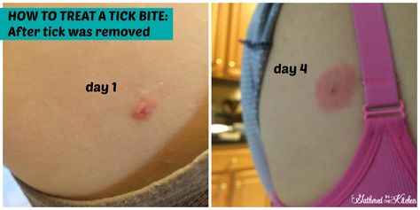 What to do if you get bite by a tick Braggs Apple Cider, Easy Diy Home Improvement, Braggs Apple Cider Vinegar, Tick Removal, Tick Bite, The Tick, Baby Bug, Busy Parents, Good To Know