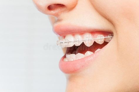 Braces Dentist, Ceramic Braces, Braces Cost, Invisalign Braces, Adult Braces, Getting Braces, Invisible Braces, Clear Braces, Braces Colors