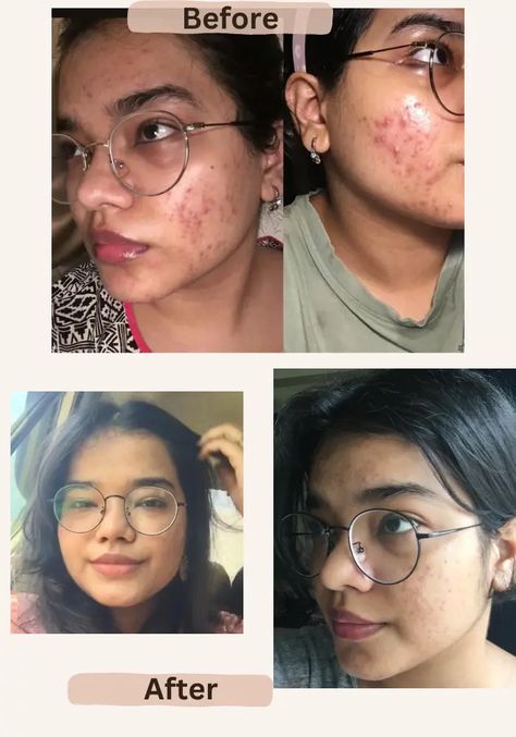 Tretinoin Before And After, Closed Comedones, People With Acne, Layers Of The Epidermis, Skincare Inspiration, Benzoyl Peroxide, Progress Pictures, How To Treat Acne, Best Skin