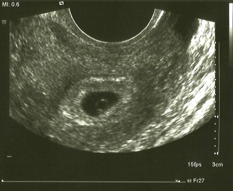 Ultrasound of the fetus at 6 weeks. You can see the egg sac and a speck of the fetus. It was still too early to see the heartbeat. 1 Month Pregnant Ultrasound, 6weeks Pregnant Ultrasound, 3 Weeks Pregnant Ultrasound, One Month Pregnant, 1 Month Pregnant, Ultrasound Prank, 6 Weeks Pregnant Ultrasound, Fb Pfp, 3 Weeks Pregnant