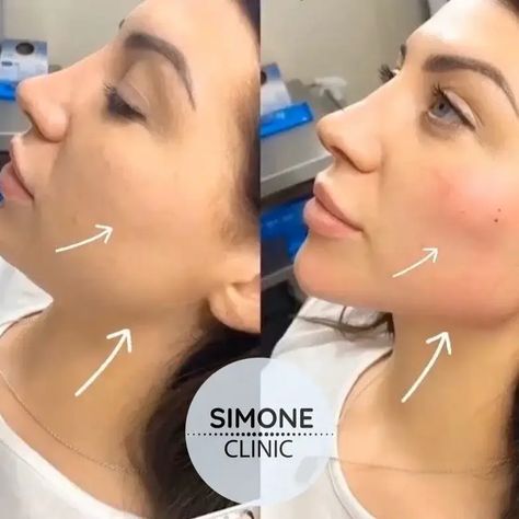 Cheek Filler Before and After Nasolabial Fold Filler, Jawline Goals, Face Plastic Surgery, Nose Surgery Rhinoplasty, Face Fillers, Botox Lips, Beauty Treatments Skin Care, Cheek Fillers, Beauty Procedures