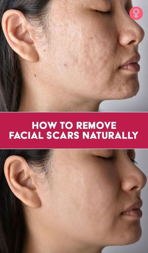 How To Remove Facial Scars Naturally: So, if you are wondering how to get rid of scars on your face naturally, let us tell you that they won’t disappear completely. However, these remedies may help fade them and minimize their appearance. We have compiled a list of the 10 best home remedies that can help scars heal over time. But first, let’s look at the science behind scars. How To Get Rid Of Scar Tissue, Remove Scars On Face, Diy Scar Removal Remedies, How To Heal Scars, How To Fade Scars, Dry Face Remedy, Skin Healing Remedies, Get Rid Of Scars, Best Acne Scar Removal