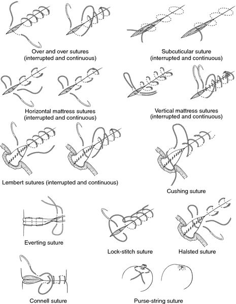 Because it is often difficult to remove stitches from children (because of their crying and difficulty in staying still), absorbable materials should be used when suturing their wounds. Description from infomedicblogspot.com. I searched for this on bing.com/images Stitches Medical, Survival Outfit, Surgical Suture, Medical Dictionary, Surgical Technologist, Vet Medicine, Surgical Tech, Vet Med, Medical Laboratory