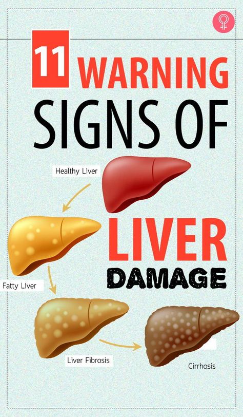 10 Warning Signs Of Liver Damage: whenever there is something wrong with the liver, it displays certain symptoms or warning signs that indicate that it isn’t working properly. Some people experience a sudden weight gain, and even though they try their best, they are unable to lose weight #liverdamage #health #wellness #healthcare Signs Of Liver Damage, Liver Damage, Liver Diet, Health Signs, Liver Detoxification, Liver Detox, Healthy Liver, Body Organs, The Liver