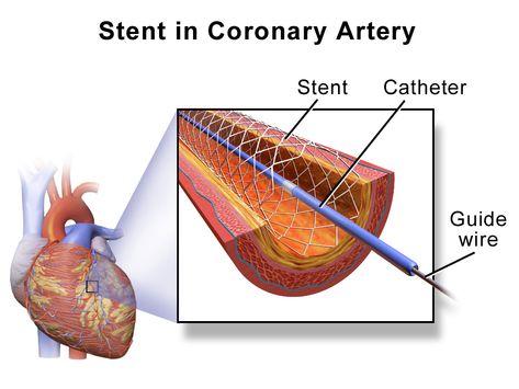 Body Supplements, Heart Stent, Heart Catheterization, Spinal Fluid, Trans Fats, Penyakit Jantung, Clogged Arteries, Heart Muscle, Coronary Arteries