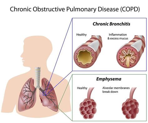 The many inflammatory faces of chronic obstructive pulmonary disease (COPD) cannot be diagnosed by simple testing. - On Medicine Chronic Cough, Chronic Obstructive Pulmonary Disease, Chest Congestion, Lungs Health, Pulmonary Disease, Respiratory Infection, Asthma Attacks, Lung Disease, Respiratory Health