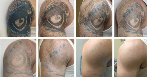 Laser Tattoo Removal stages Stage Tattoo, Tattoo Removal Laser, Remove Tattoo, Tattoo Removal Cost, Faded Tattoo, Vegas Tattoo, Tattoo Maker, Tattoo Cream, Street Tattoo