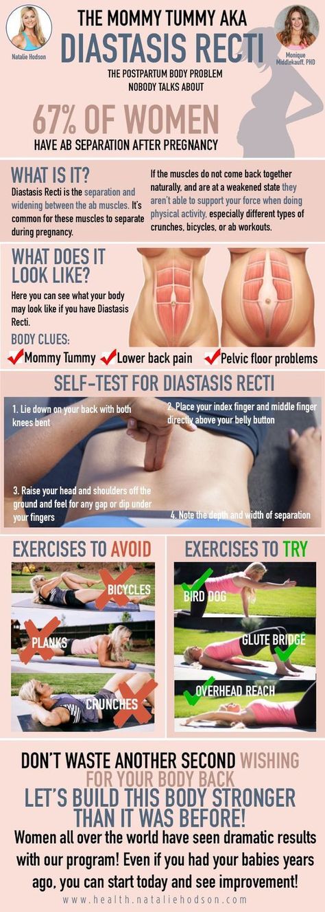 How to fix Diastasis Recti Diastis Recti Exercises Before And After, Diastis Recti Before And After, Mommy Workout Mummy Tummy, Rectus Diastasis Workout, Diastis Recti Exercises Workout, Diastasis Recti Before After, Hernias In Women, Diastis Recti, Postpartum Exercises