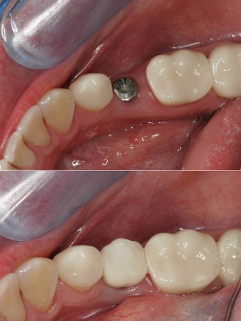 Dental implants are the preferred method of replacing a missing tooth because you can brush and floss around it more easily than a bridge. Dental Bridge Cost, Tooth Extraction Aftercare, Implants Dental, Tooth Extraction Healing, Tooth Implant, Affordable Dental Implants, Dental Implant Procedure, Bridge House, Dental Implants Cost