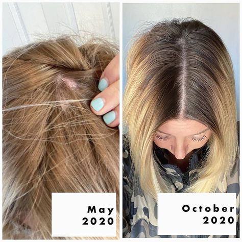 Monat Before And After, Monat Hair, After 4, 4 Months, Hair Skin, Bobby Pins, Hair Accessories, Instagram Post, Skin