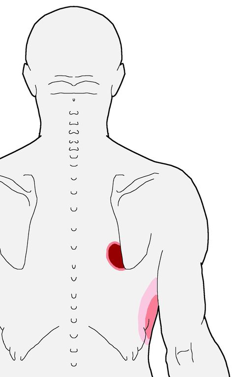 Trigger Points – Nagging Pain Inside The Bottom of the Shoulder Blade | Integrative Works Shoulder Pain Remedies, Punkty Spustowe, Mid Back Pain, Shoulder Pain Relief, Back Pain Remedies, Upper Back Pain, Relieve Back Pain, Trigger Points, Fitness Advice