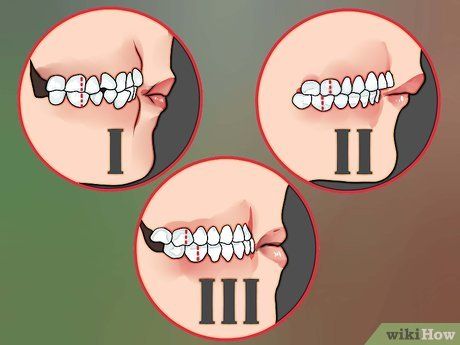 Overbite Before And After, Teeth Surgery, Dental School, The Teeth, Surgery, Comic Art, Pins, Quick Saves, Art