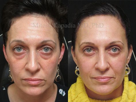 Eye Bag Surgery, Facial Aging, Under Eye Fillers, Injectables Fillers, Excess Skin, Under Eye Puffiness, Celebrities Before And After, Eye Surgery, Under Eye Bags