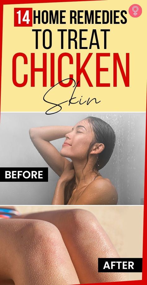 14 Home Remedies To Treat Chicken Skin: While chicken skin or keratosis pilaris cannot be eliminated altogether, you can reduce the severity and make the red marks fade away with the right methods. You will need to opt for both internal and external solutions. #remedies #chickenskin #skincare #skincaretips Chicken Skin Remedy, While Chicken, Natural Headache Remedies, Keratosis Pilaris, Natural Sleep Remedies, Chicken Skin, Red Marks, Skin Remedies, Care Tips