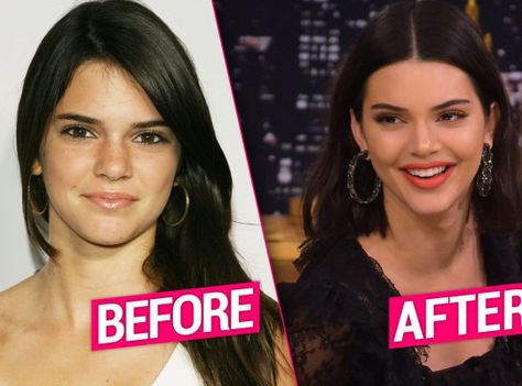 Kendall Jenner's Plastic Surgery Exposed By Top Docs Kendall Jenner Surgery, Kendall Jenner Plastic Surgery, Kylie Jenner Plastic Surgery, Plastic Surgery Pictures, Bad Celebrity Plastic Surgery, Bad Plastic Surgeries, Kendall Jenner Face, Plastic Surgery Photos, Plastic Surgery Gone Wrong