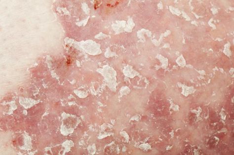 New research suggests the more severe a person's psoriasis is, the more likely they are to have increased blood vessel inflammation - a condition known as vasculitis. Fungal Rash, Dry Skin Body, The Skin, Sleep, Skin, Health