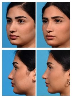 Nose Job Tip Reduction, Nose Job Front Profile, Nose Job Before And After Front View, Rhinoplasty Before And After Bulbous, Nose Inspo Front View, Straight Nose Front View, Nose Job Inspiration Front View, Nose Job Inspo Front View, Subtle Nose Job