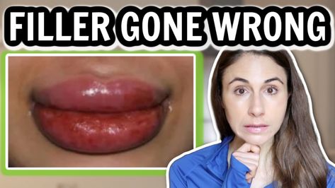 Dermatologist on the top 5 complications from filler injections. Dr Dray, Cosmetic Fillers, Dermatologist Doctor, Injectables Fillers, Lip Filler, Gone Wrong, Lip Fillers, On The Top, Makeup Skin Care