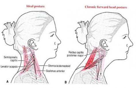 Shoulder Raises, Text Neck, Alexander Technique, Neck Problems, Forward Head Posture, Pinched Nerve, Shoulder Muscles, Body Posture, Poor Posture