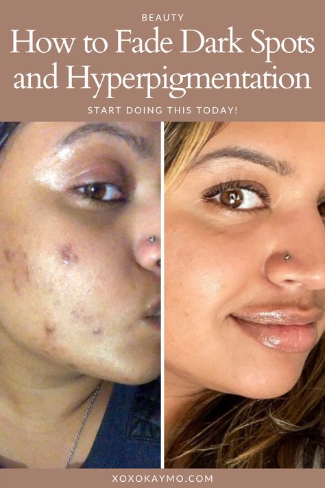 How to Fade Dark Spots and Hyperpigmentation Acne happens, and sometimes we have the scars left over to prove it. If you have darker skin tones, acne blemishes tend to linger long after the pimple disappears. There are products and methods you can implement today to get rid of these dark spots and hyperpigmentation quick. How To Get Rid Of Acne And Dark Spots, How To Remove Blemishes From Face, Hyper Pigmentation On Face, Best Skin Care Products For Acne Dark Spots, Pimple Scar Removal Dark Spots, Dark Acne Spots Remedies, How To Remove Hyperpigmentation On Face, How To Fade Acne Marks, How To Remove Dark Spots