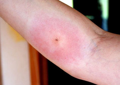 http://firstaid.about.com/od/bitesstings/ig/Spider-Bite-Pictures/White-Tail-Spider-Bite.htm Spider Bite Symptoms, Spider Bites Pictures, Bug Bites Remedies, Home Remedies For Spiders, Turmeric Uses, Spider Bite, Get Rid Of Spiders, Bed Bug Bites, Spider Bites