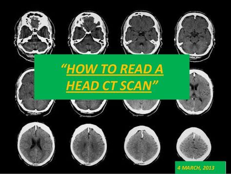 “HOW TO READ A HEAD CT SCAN”                 4 MARCH, 2013 Ct Brain, Nurse Ratchet, General Knowledge Questions And Answers, Mri Brain, Brain Nerves, Class Presentation, Head Anatomy, Basic Physics, General Knowledge Questions