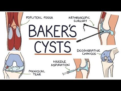 (7) Understanding Baker's Cysts (Popliteal Cysts) - YouTube Medicine Student, Knee Exercises, Healthcare Professionals, Health Tips, Health Care, Medicine