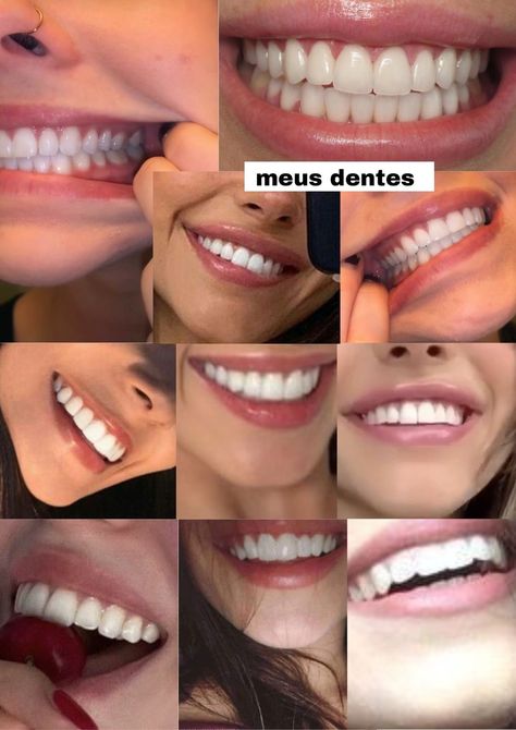 Perfect Teeth Vision Board, Snow White Skin Aesthetic, Teeth Glow Up, Teeth Manifest, Good Teeth Aesthetic, Nice Teeth Smile Aesthetic, Small Teeth Smile, Perfect Smile Teeth Women, Braces Before And After Glow Up