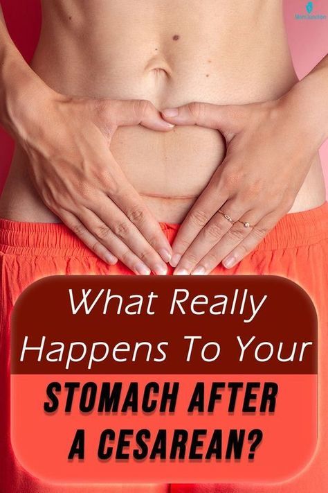 Postpartum Products, Shrink Stomach, Normal Birth, Stomach Muscles, Abdominal Surgery, Light Exercise, Healthy Lifestyle Habits, Mom Junction, Trying To Sleep