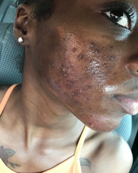 I used to suffer from hormonal & cystic acne. From around 2007-2019 I was going back & forth to the dermatologist. It was hell. My skin got worst & worst. The scarring, the dark spots, the texture, the enlarged pores & inflammation put me in a terrible mental health crisis at times. I was caking on makeup & picking my skin every single day. I went & got shots at the derm for the under the skin cysts several times a month. I spent 1,000s of dollars...I even tried #accutane but I relapsed. It g... Hormonal Cystic Acne, Acne Women, Pimples On Face, Bleaching Cream, Severe Acne, Under The Skin, Mental Health Crisis, Scarring, Cystic Acne