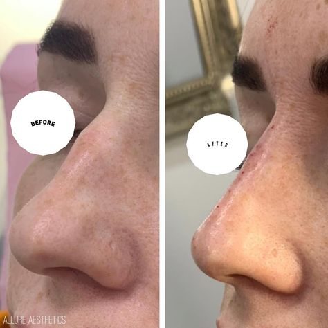 Refined Nose Tip, Nose Hump Aesthetic, Nose Filler, Nose Fillers, Natural Face Cleanser, Baby Feeding Schedule, Notting Hill London, Flat Nose, Nose Job