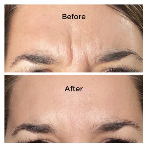 Forehead Botox Results Botox Results, Forehead Wrinkles, Botox Injections, Medical Spa, 4 Months, Anger, Self Care, Wrinkles, Mood Board