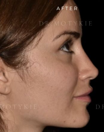 Nose Inspiration, Straight Nose Side Profile, Perfect Nose Front View, Rhinoplasty Side Profile, Ideal Nose Rhinoplasty, Rhinoplasty Before After Wide Nose Jobs, Nosejob Rhinoplasty Before After, Perfect Side Profile, Thick Skin Bulbous Tip Rhinoplasty