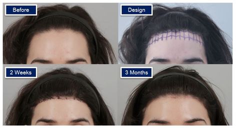 This is a very popular surgery in Korea. It is used to lower the hairline to create a more feminine forehead size and shape. #idhospital #idhospitalkorea #plasticsurgery #koreanplasticsurgery #surgeryinkorea #koreanplasticsurgerybeforeandafter #foreheadreduction #hairlinelowering #scalpadvancement #facialfeminizationsurgery #transformation Big Forehead Bangs, Hairline Surgery, Ffs Surgery, Living So Good, Forehead Bangs, Plastic Aesthetic, Beauty Surgery, Forehead Reduction, Korean Plastic Surgery