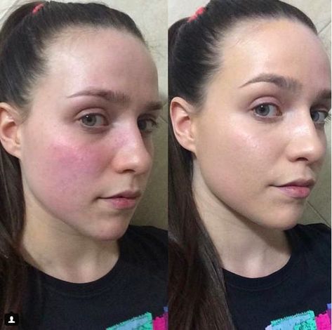 Redness Remedy, Redness On Face, Mascara Hacks, Imagenes Mary Kay, Skin Structure, Learn Yoga, Skin Redness, Sensitive Skin Care, Skin Remedies