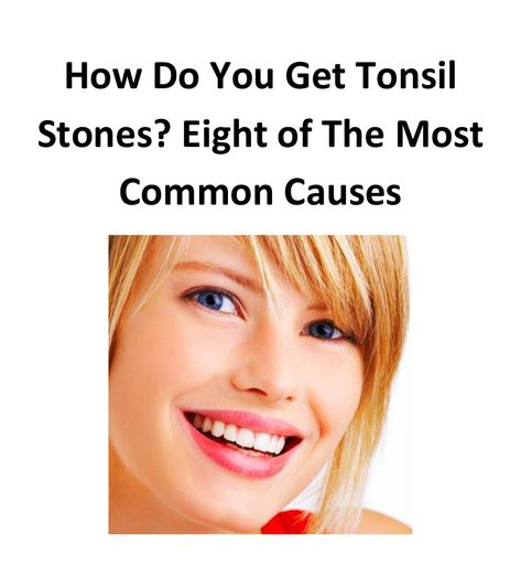 How Do You Get Tonsil Stones? Eight of The Most Common Causes, How do you get… Tonsil Stones Removal, Tonsil Stone Removal, Chronic Sore Throat, Throat Infection, Home Beauty Tips, Dead Cells, The Immune System, Good Mental Health, Oral Hygiene