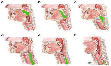 Dysphagia or trouble swallowing can often be caused by LPR. If you have dysphagia and are unsure of the cause read this review and try Peptest to determine if you are refluxing pepsin and other gastric contents. Dysphagia Therapy, Swallowing Problems, Feeding Therapy, Fonio, Drain Cleaners, Oral Motor, Speech Path, Speech Therapy Resources, Speech Activities