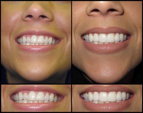 Natural Looking Veneers Teeth, Porcelain Veneers Before And After, Veneers Before And After, Perfect Teeth Smile, Natural Veneers, Natural Teeth Whitening Remedies, Dental Aesthetics, Veneers Teeth, Dental Work