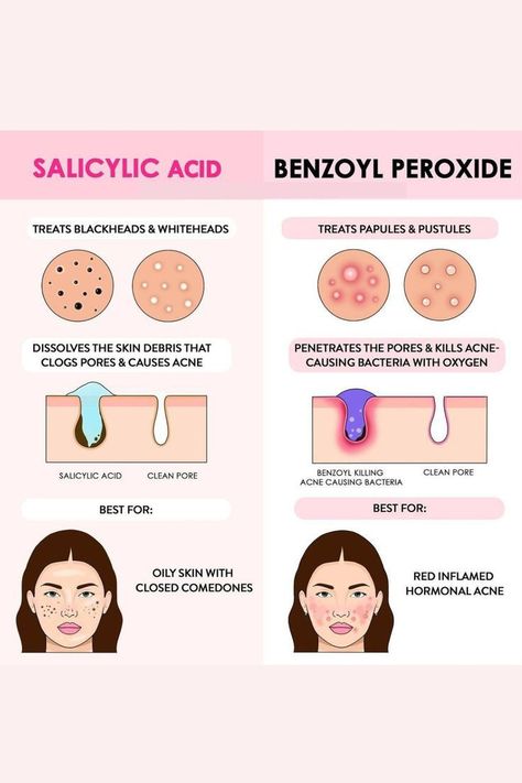 Salicylic Acid Benefits, Back Acne, Types Of Acne, Skin Science, Skin Detox, Hormonal Acne, Lack Of Energy, Benzoyl Peroxide, Vitamins For Skin