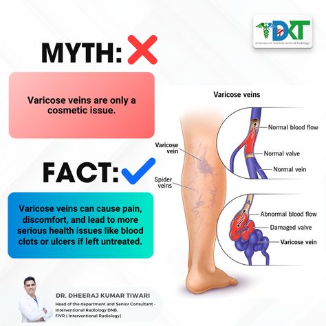 Ready to bust some myths about varicose veins? 💥 Let’s unravel the truths together! Who's with me on this? 🚀 . #varioseveins⁣ #varicosevein⁣ #VaricoseVeinRelief⁣ #VascularIntervention⁣ #RadiologyEducation⁣ #MedicalAd Anatomy Presentation, Interventional Radiology, Amazing Science Facts, Best Hospitals, Science Facts, Lifestyle Tips, Radiology, Blood Flow, Health Issues