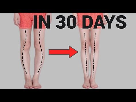 Get Straight Legs in 30 Days! Fix O or X-Shaped Legs (Knee Internal Rotation) - YouTube Bow Legged Correction, Leg Challenge, Knock Knees, Belly Workout Challenge, Bow Legged, Longer Legs, Daily Workout Plan, Body Weight Leg Workout, Workout For Flat Stomach