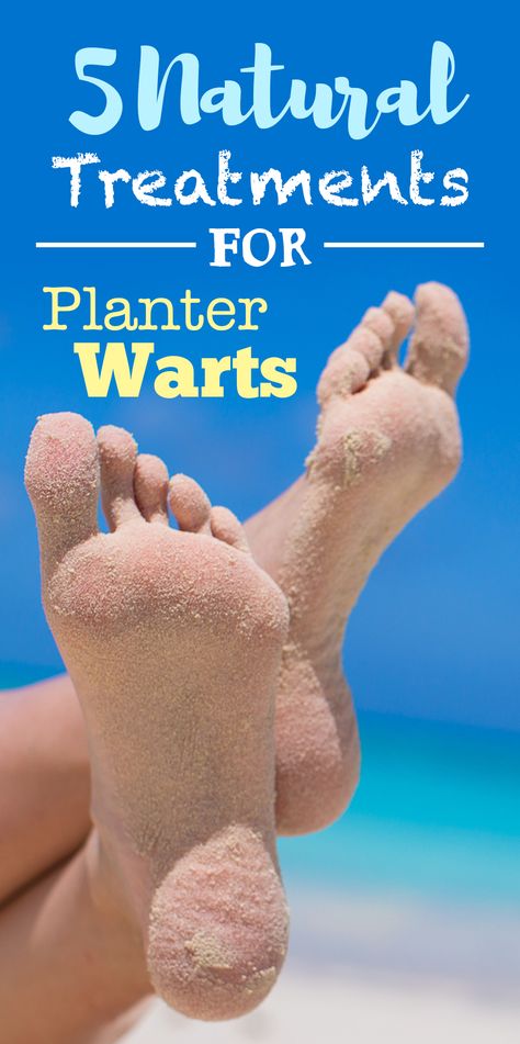 How and Why To Treat Plantar Warts Naturally (5 Ways) Planters Wart, What Causes Warts, Warts On Hands, Warts On Face, Skin Wars, Get Rid Of Warts, Home Remedy For Cough, Cold Sores Remedies, Natural Sleep Remedies