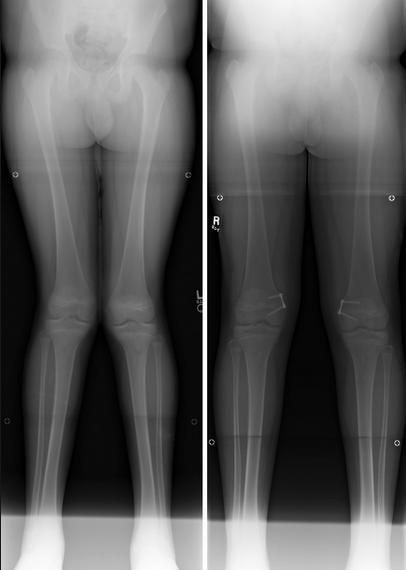 Genu Valgum (knocked knees) - Pediatrics - Orthobullets Knocked Knees, Genu Valgum, Knock Knees, Human Body Anatomy, Body Anatomy, Online Community, Pediatrics, Workout Videos, Anatomy