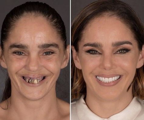 Botox Nose, All On 4 Dental Implants, Teeth Makeover, Permanent Dentures, Jaw Reduction Surgery, Teeth Caps, Plastic Surgery Gone Wrong, Makeup Vs No Makeup, Face Surgery