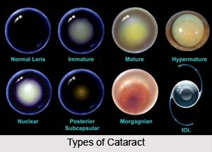 Optician Training, Optometry Education, Eye Floaters Causes, Eye Facts, Eye Anatomy, Eye Exercises, Eye Surgery, Eye Doctor, Eye Drops