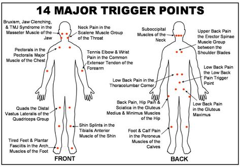 What is Trigger Point Therapy? Acupuncture Benefits, Trigger Point Massage, Massage Therapy Techniques, Trigger Point Therapy, Ten Unit, Cupping Therapy, Trigger Point, Massage Benefits, Medical Anatomy