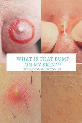 “Quite often I’ve had some type of new bump somewhere on the body. .. and Googling it can be quite frustrating when there are so many types of bumps, rashes, pimples etc out there. And believe it or not – I’ve had about 10 enquiries in the last MONTH about pimples, pus and pustules! So here are all the lumps, bumps, itches and pus that you could have on your face (and other places!)” Skin Bumps On Face, Soccer Positions, Blind Pimple, Pimples Under The Skin, Pimples On Face, Skin Bumps, Acne Mask, Skin Care Routine 30s, Natural Acne